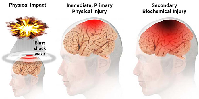 traumatic brain injury after explosion