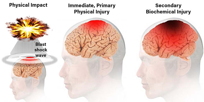 Primary Vs Secondary Brain Injury