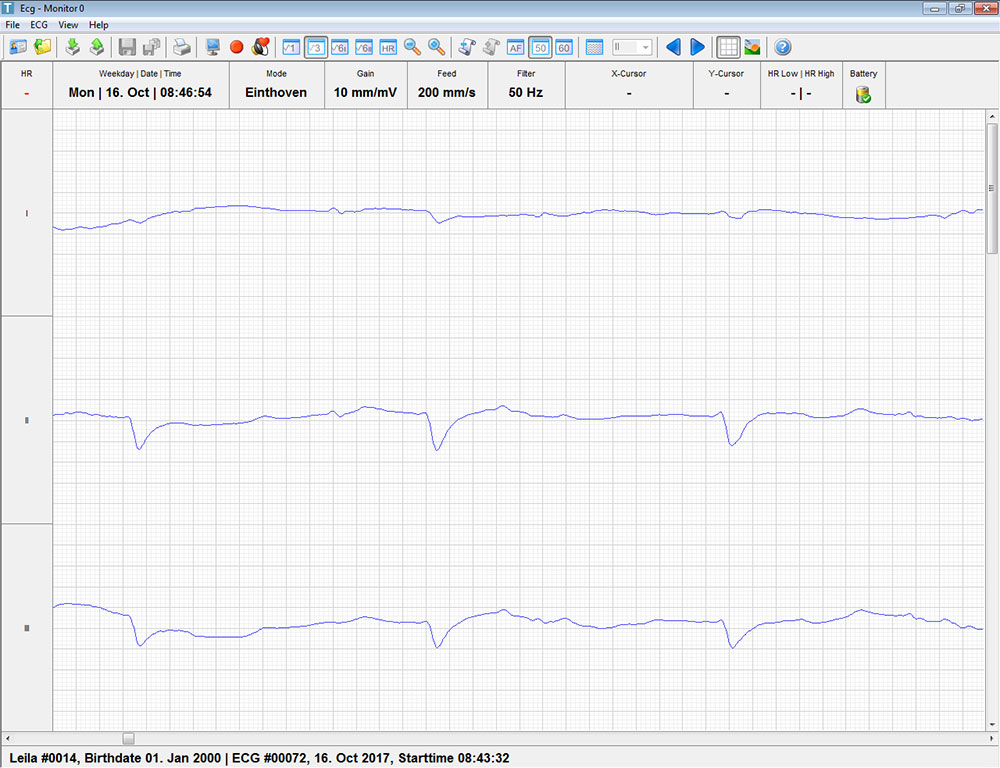 The Electrocardiogram reading for a horse on the treadmill