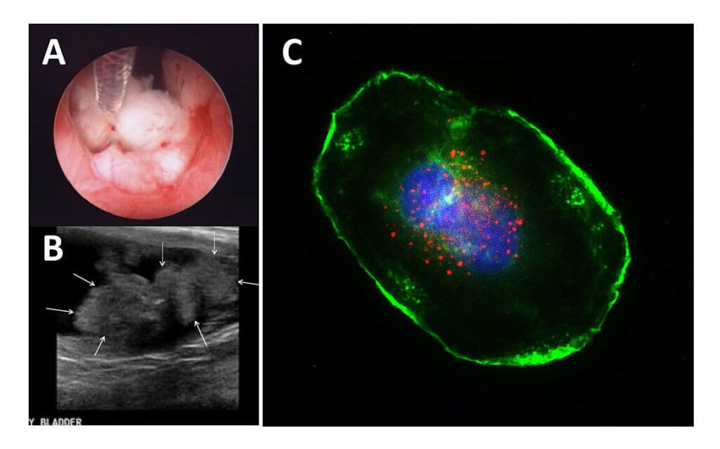a collection of bladder biopsy and scan images