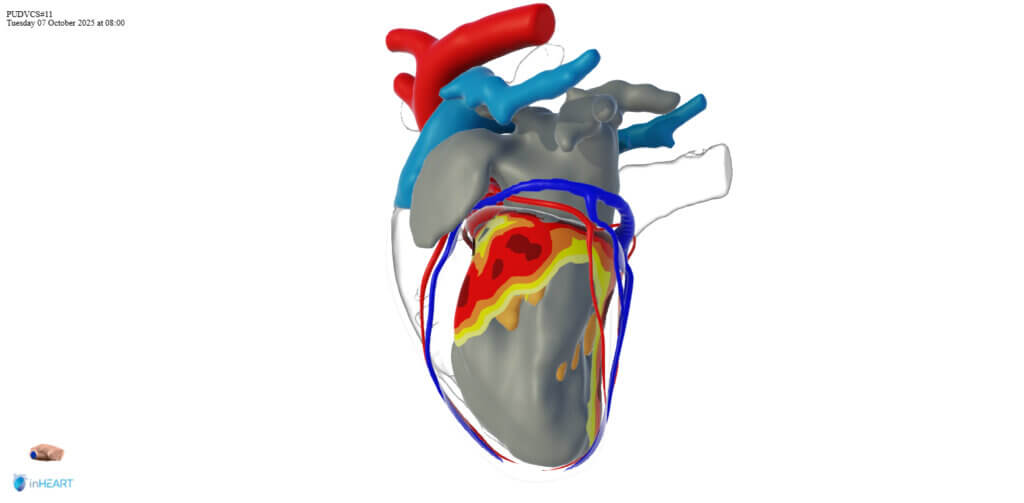 This image is a digital rendering of the patient's heart before the surgery. The anatomy is highlighted in the diagram by color